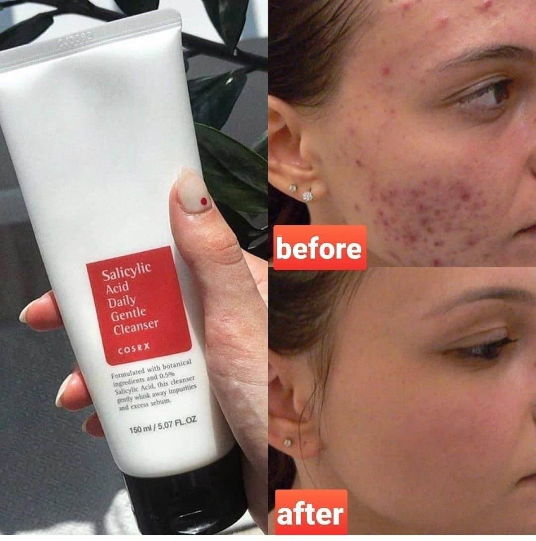 Oily & Acne-Prone Skin Routine Set – 4-Step Skincare Kit - Skincare Set - Dr. Araby, The Ordinary, COSRX -- United Arab Emirates -- Pinky Cosmetics
